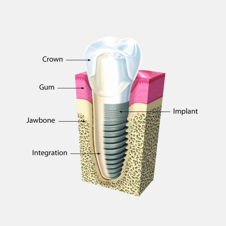 Dental Implant Diagram GREY - Luke Dunn Dental